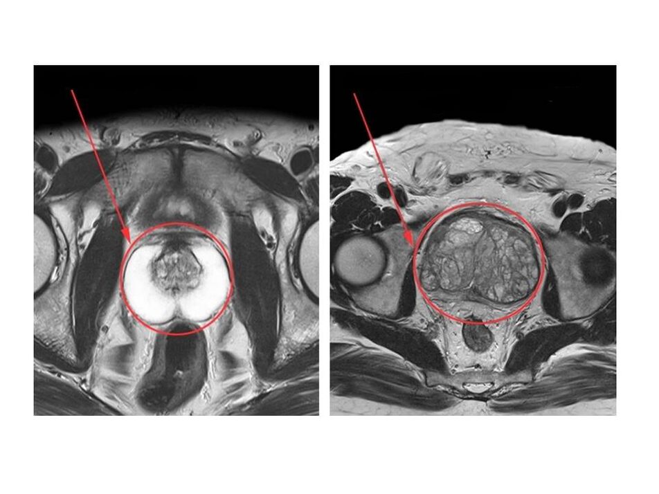 Terve (vasakul) ja põletikulise (paremal) eesnäärme võrdlus MRI piltidel